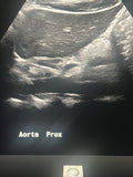 Aorta