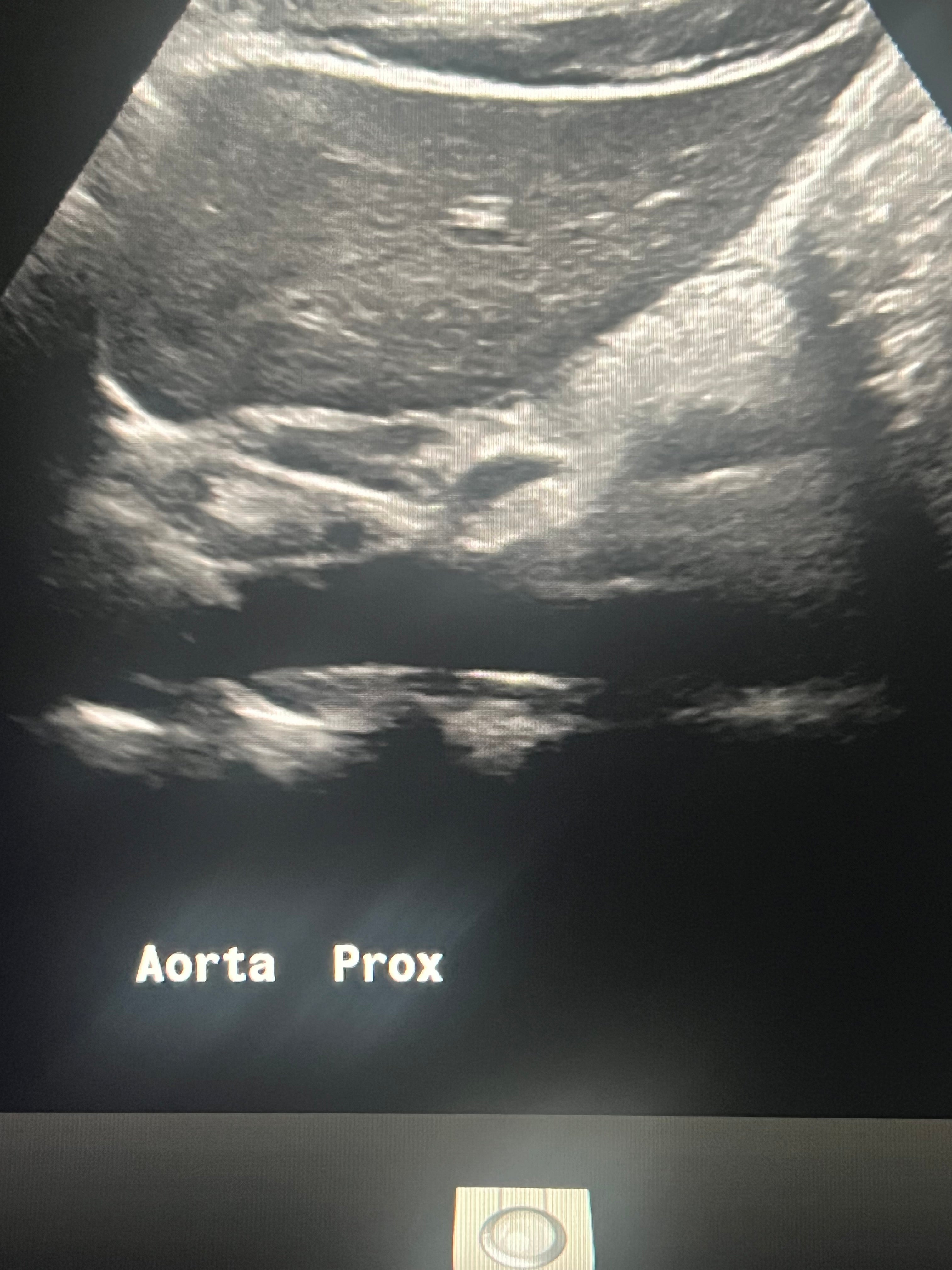 Aorta