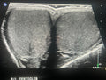 Scrotum