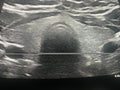 Thyroid