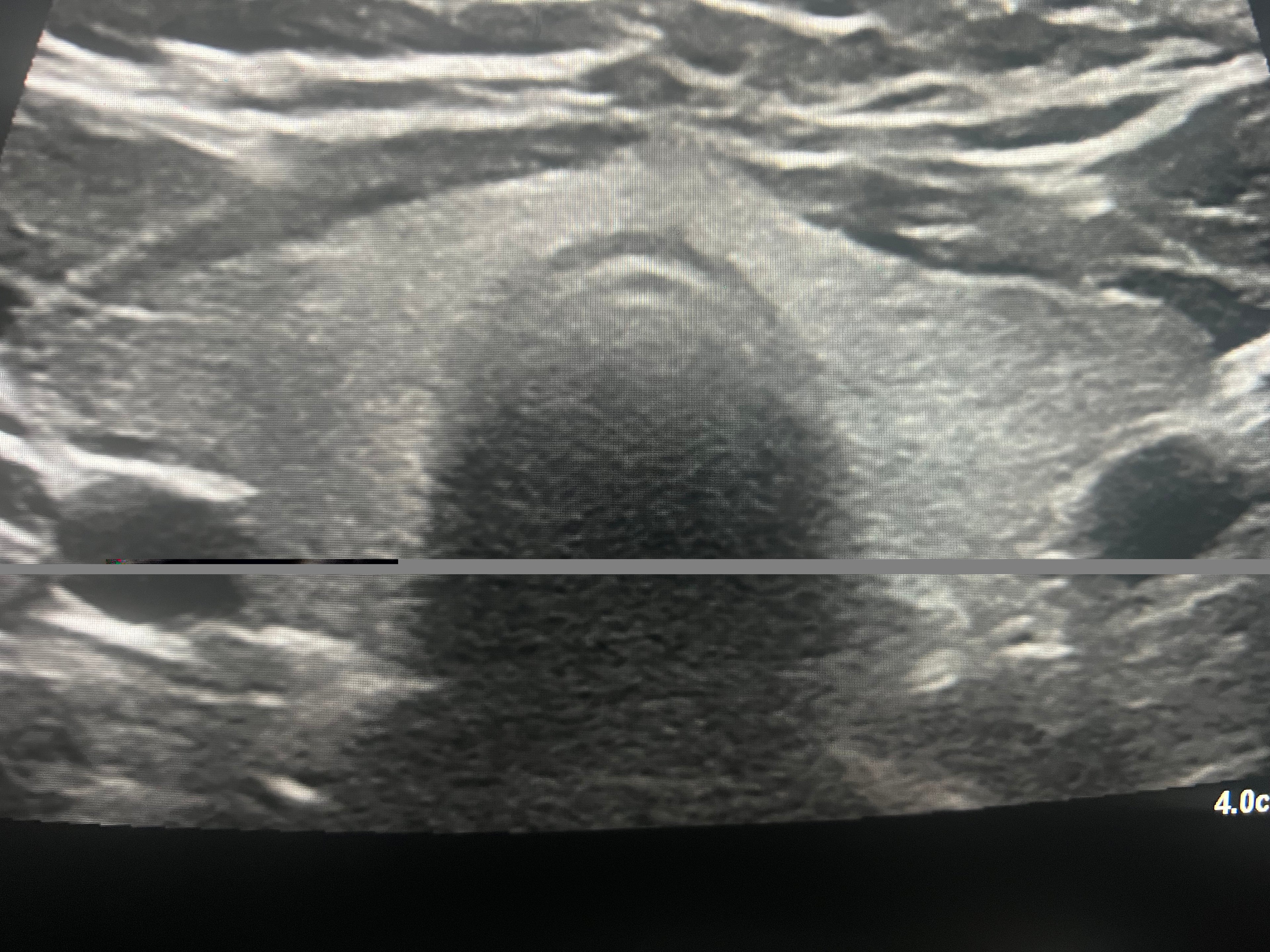 Thyroid