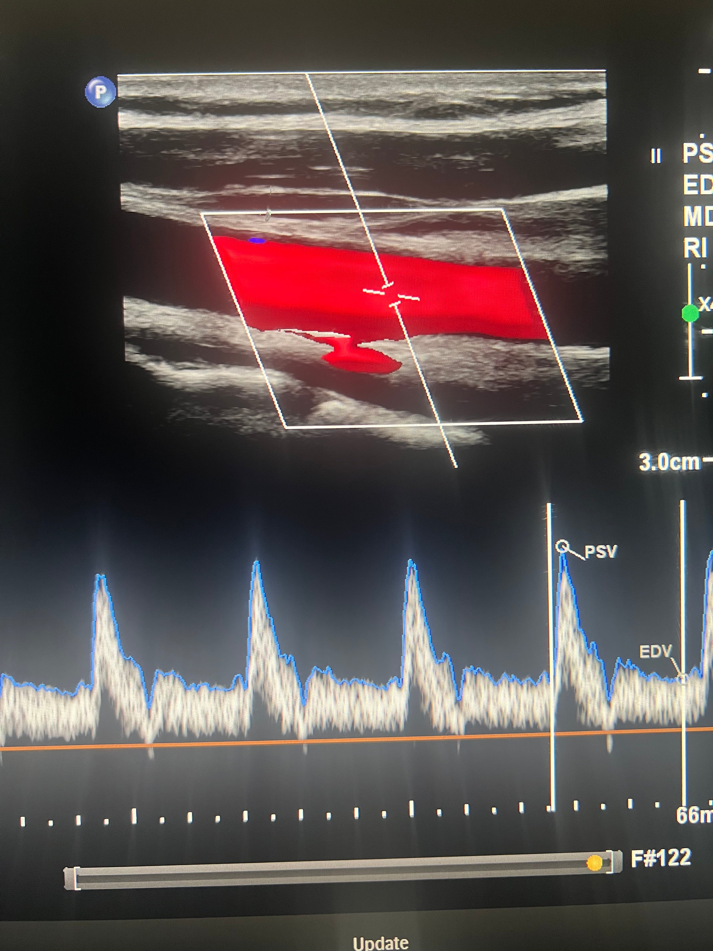 carotid review