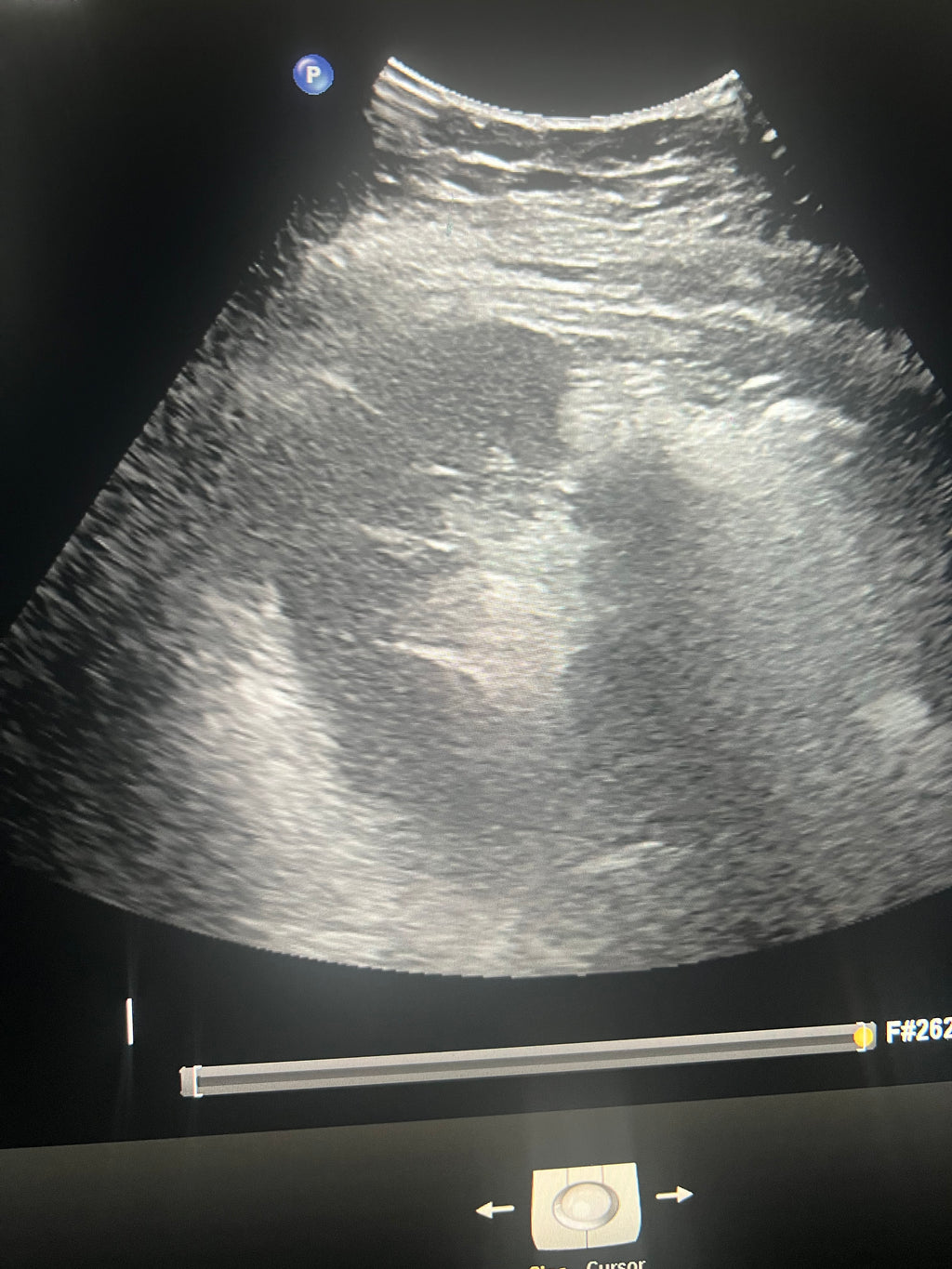 Spleen review