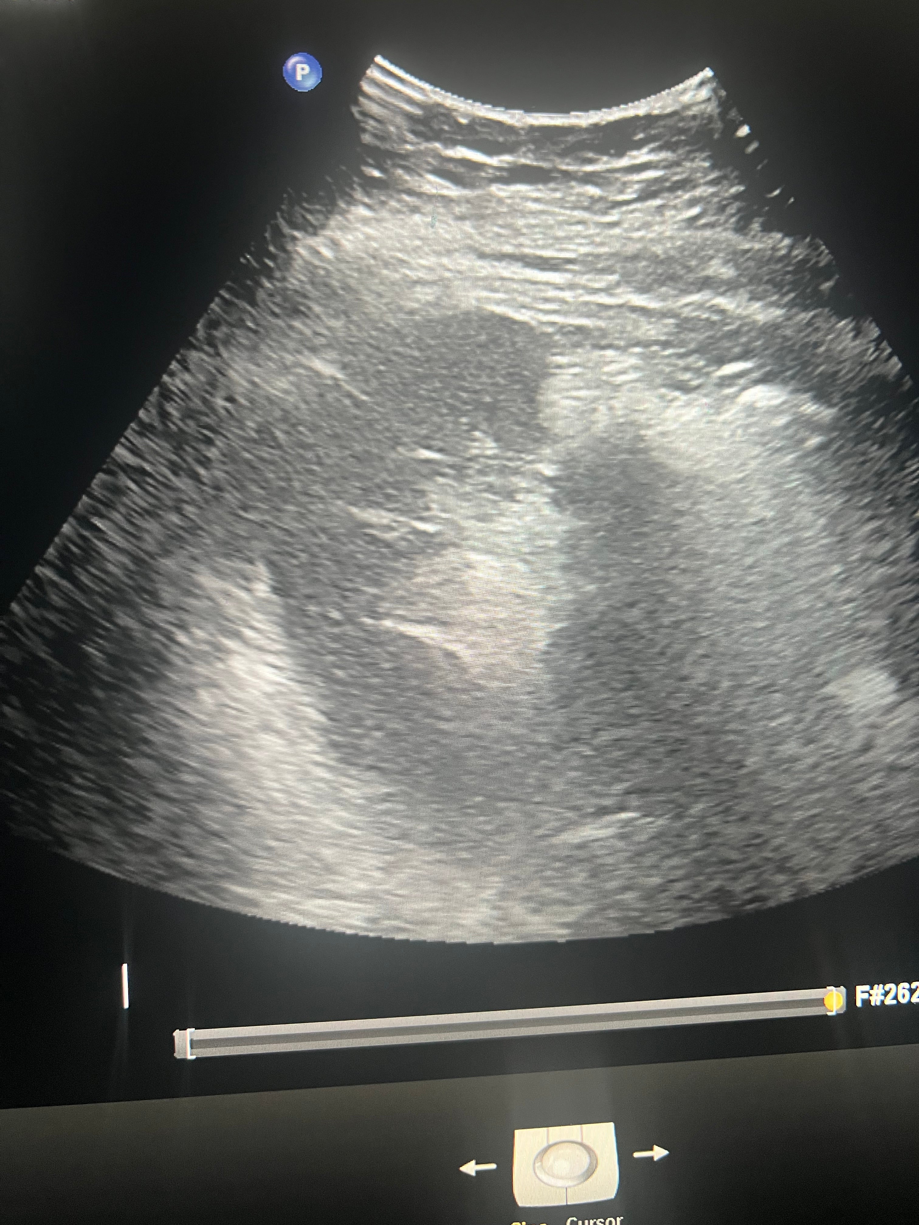 Spleen review
