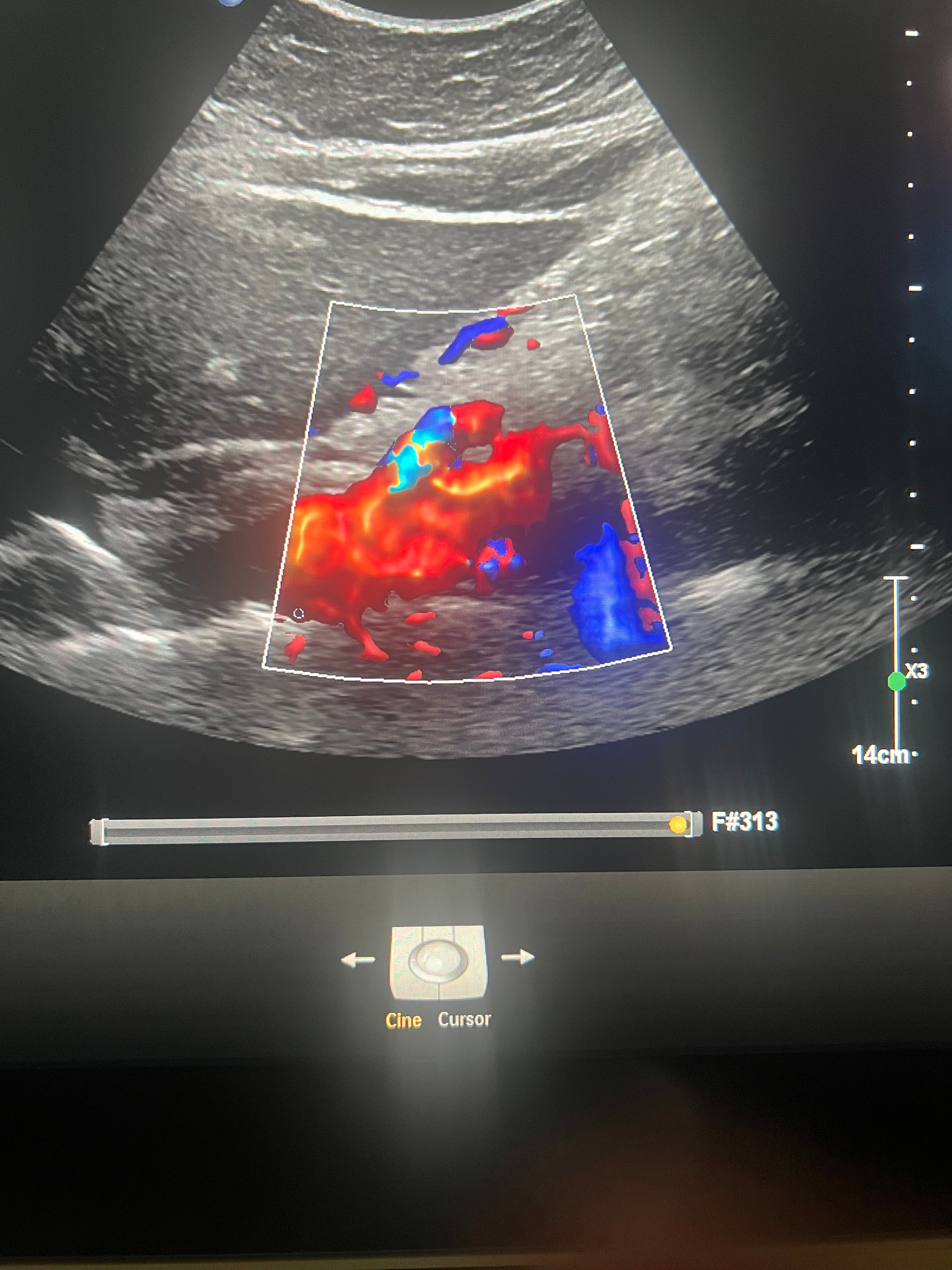 Mesenteric doppler