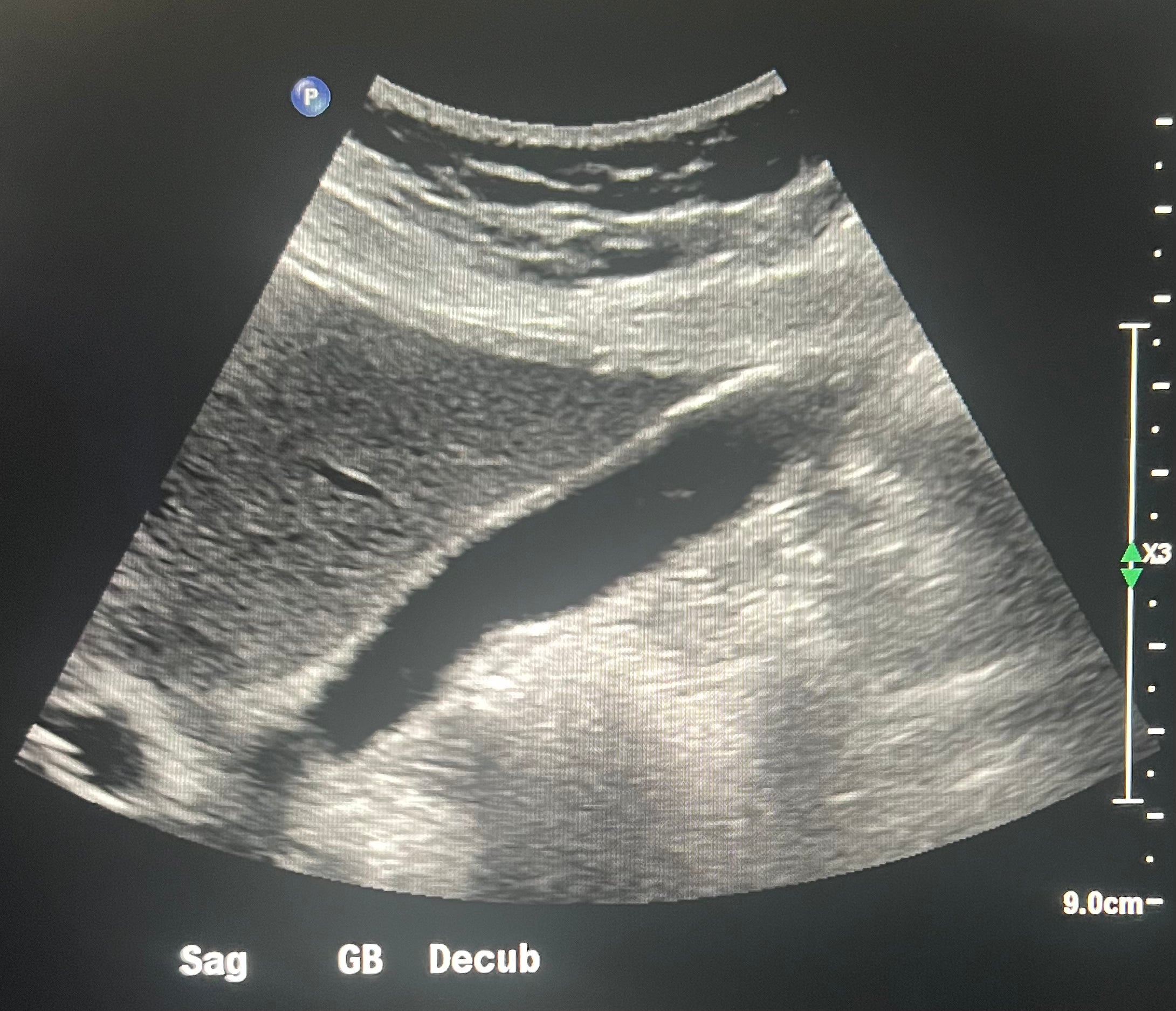 Gallbladder review