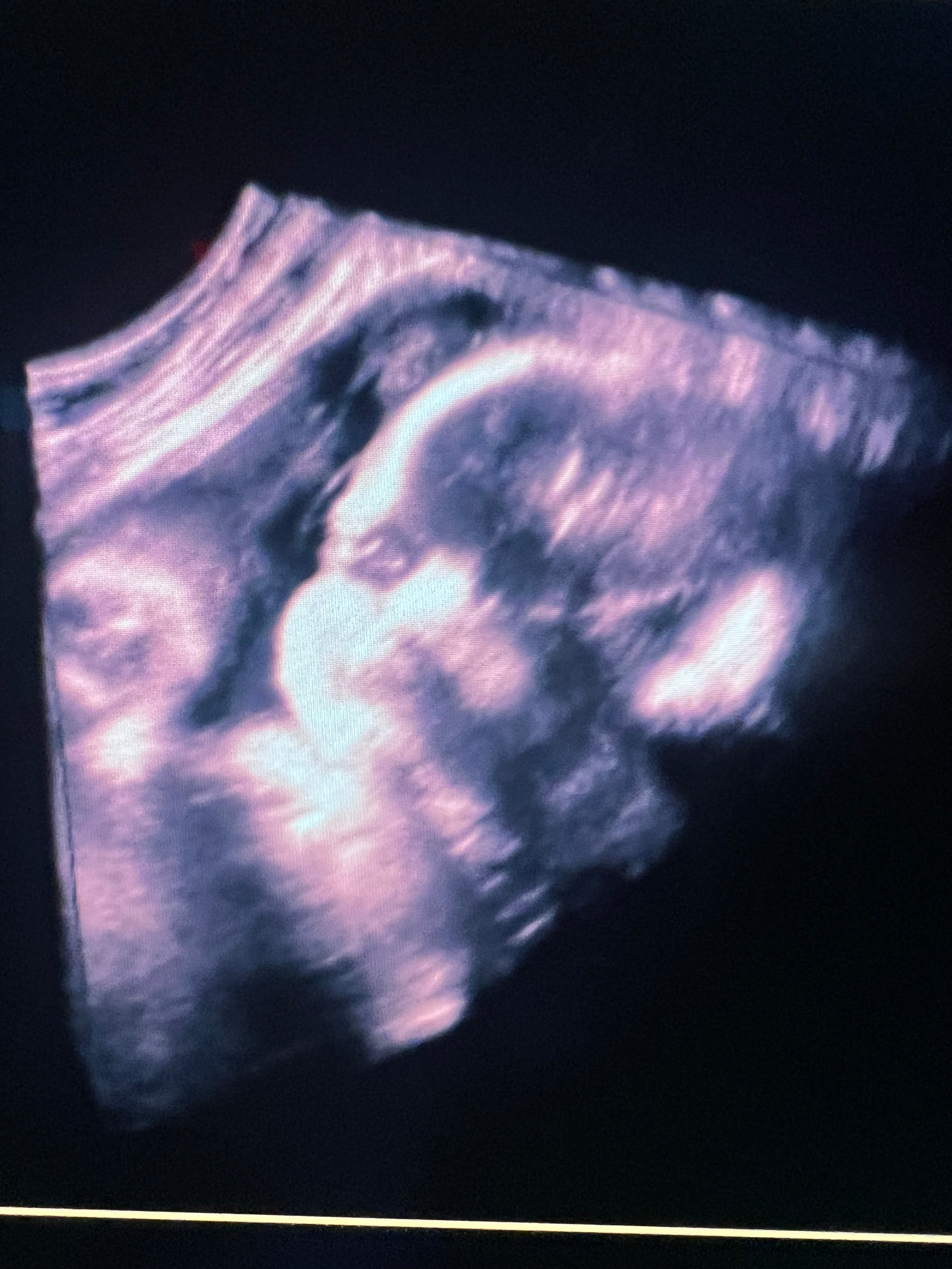 Trisomy review
