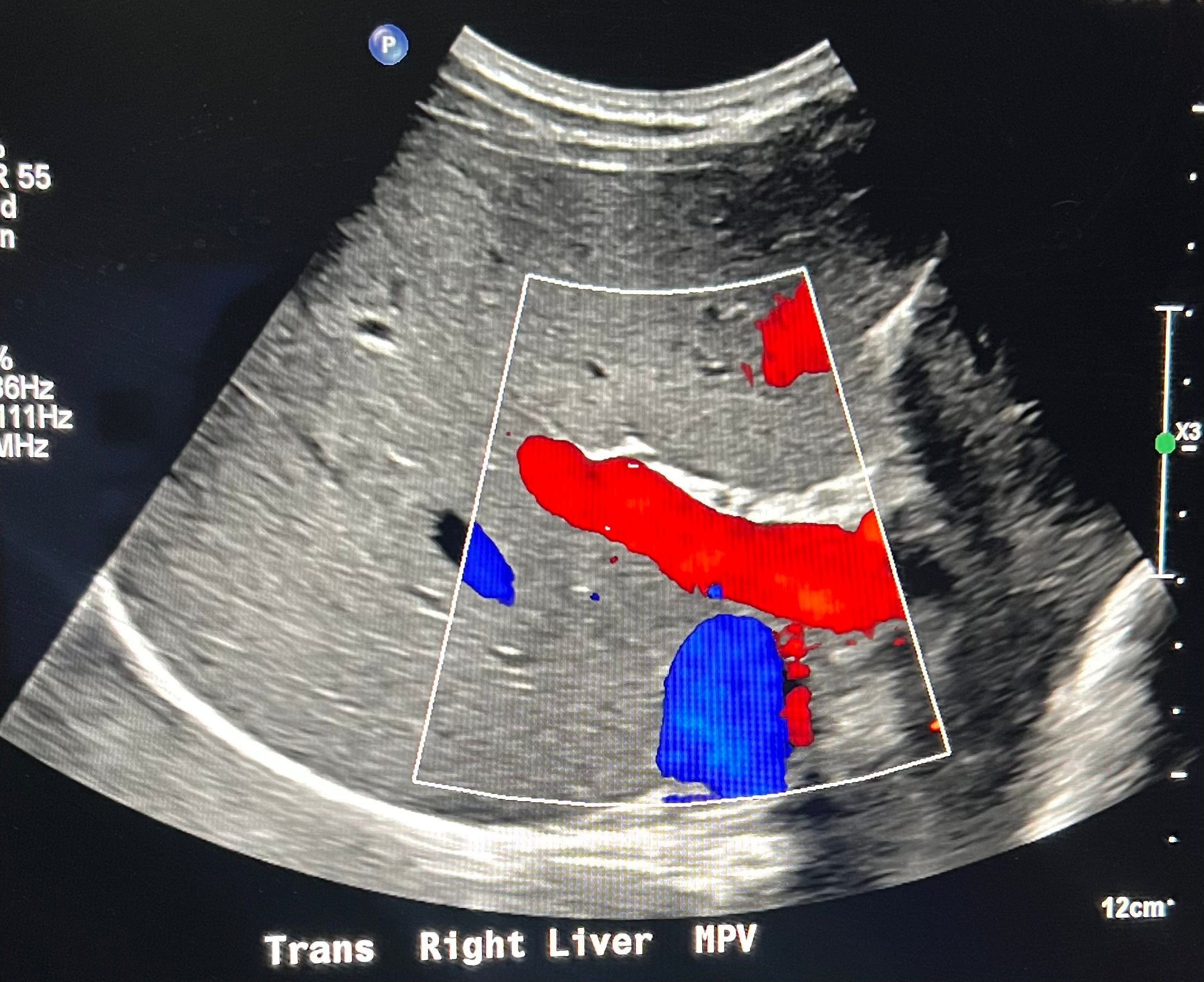 Main Portal Vein